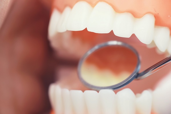 Signs You Need a Deep Dental Cleaning